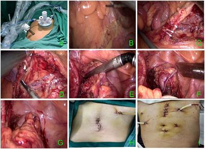 Clinical application of two-port laparoscopic surgery in sigmoid colon and upper rectal cancer resection